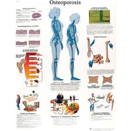FABRICATION ENTERPRISES 3B® Anatomical Chart - Osteoporosis, Paper 12-4615P